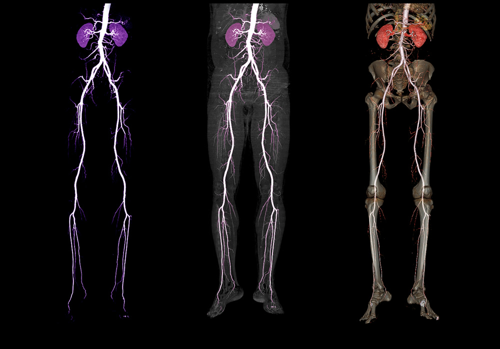 3d-artery-imaging